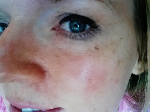 Laser Skin lightening utah
