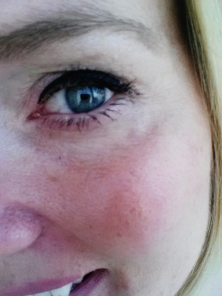 laser skin lightening results